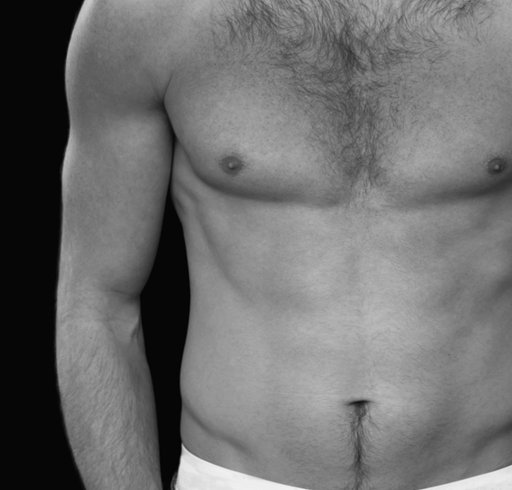 Gynecomastia