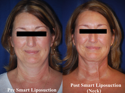 smart-lipo-of-neck-1