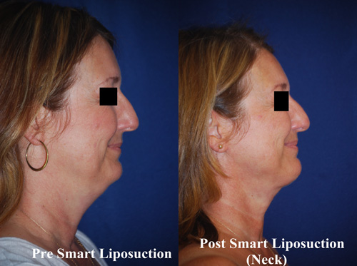 smart-lipo-of-neck-2