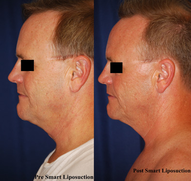 smart-lipo-of-neck-4
