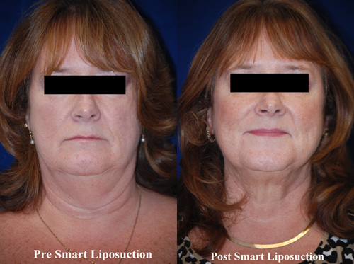 smart-lipo-of-neck-5