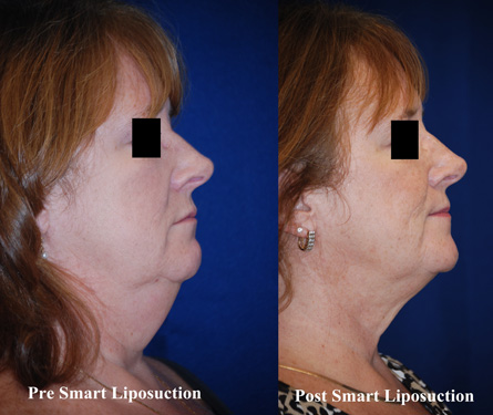 smart-lipo-of-neck-6