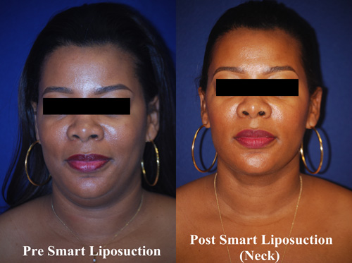 smart-lipo-of-neck-7