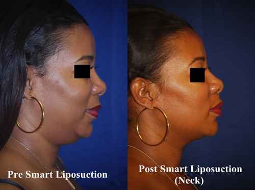 smart-lipo-of-neck-8