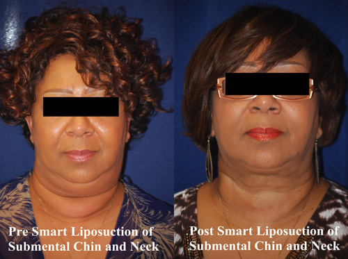 smart-lipo-of-neck-9