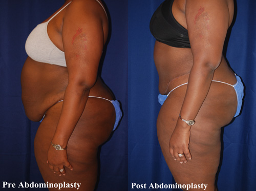 tummy-tuck-surgery-hampton-10
