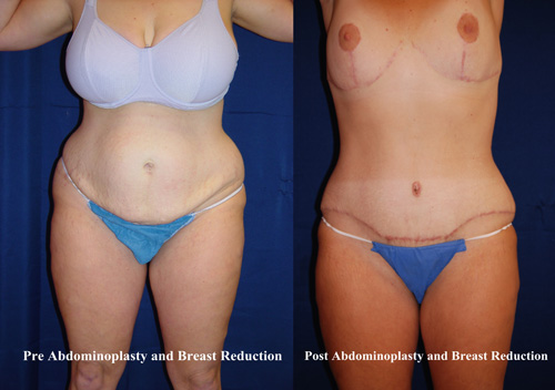 tummy-tuck-surgery-hampton-5