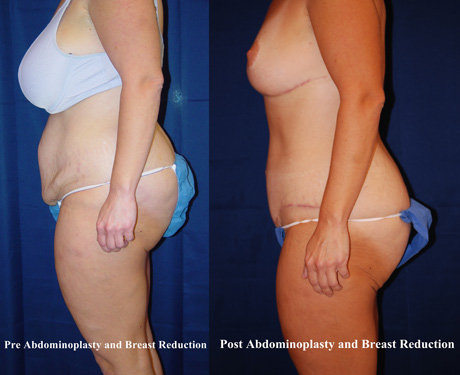 tummy-tuck-surgery-hampton-6