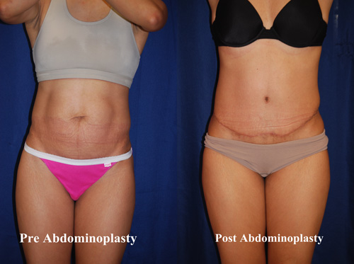 tummy-tuck-surgery-hampton-7
