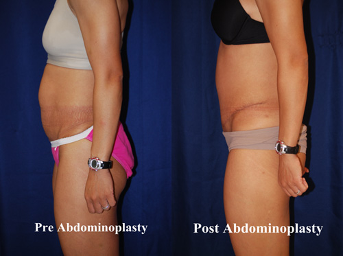 tummy-tuck-surgery-hampton-8
