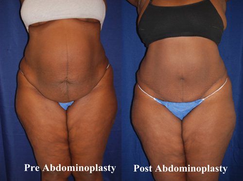 tummy-tuck-surgery-hampton-9